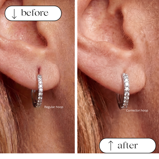 Wilma Corrector Hoop before and after on a stretched earlobe: regular hoop sags, corrector hoop sits higher. Implant grade titanium.